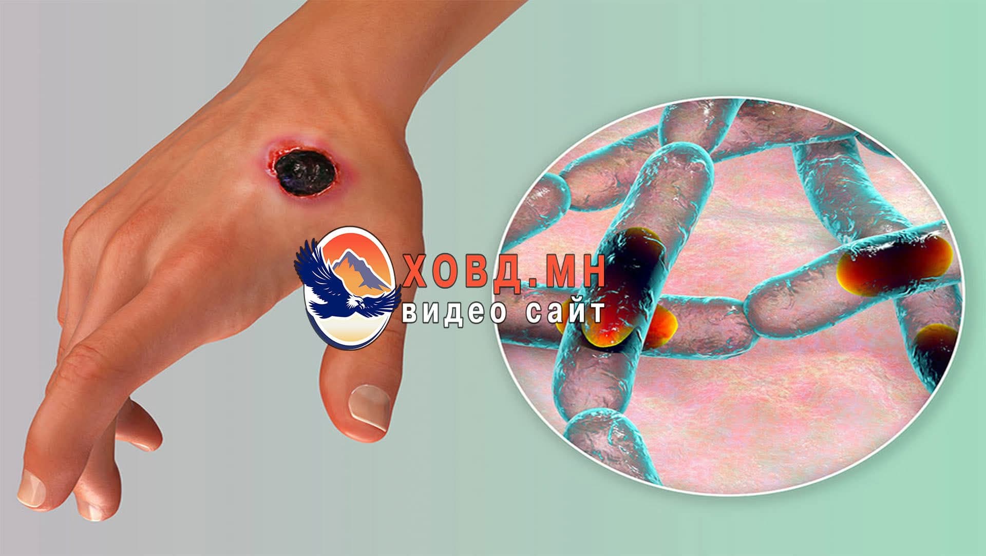 Боом өвчний нян нь хөрсөнд 100 жил усанд 60 жил хадгалагддаг